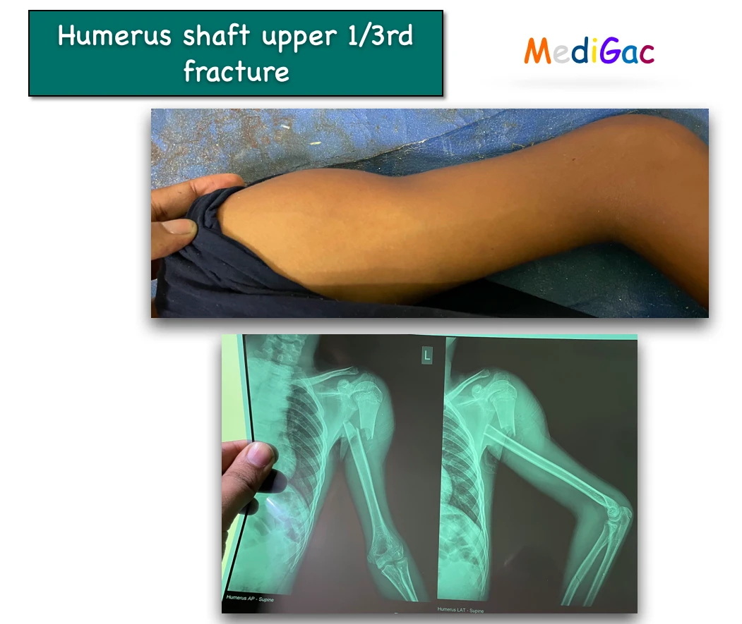 Humerus shaft fracture in upper 1/3rd